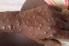 La Mauritanie en alerte après la détection d’un premier cas de Mpox au Sénégal