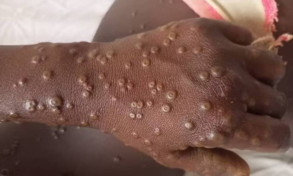 La Mauritanie en alerte après la détection d’un premier cas de Mpox au Sénégal
