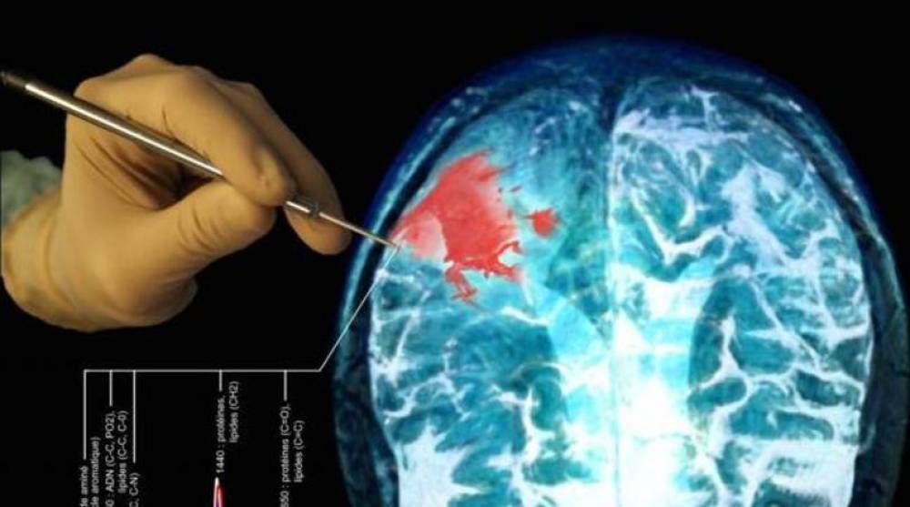 Un nouveau dispositif pour détecter les cellules cancéreuses sans chirurgie développé en Australie