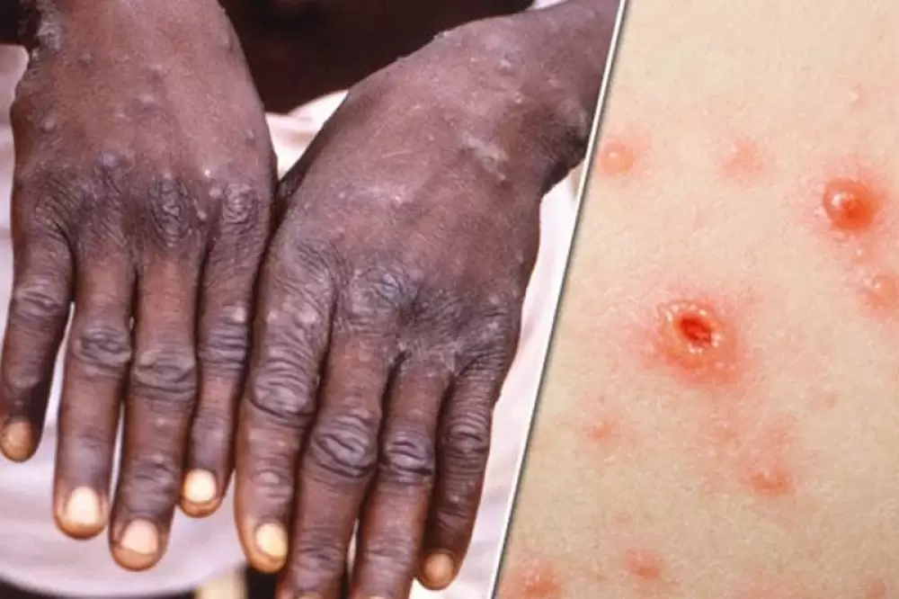 Le Maroc enregistre 1 premier cas de Monkeypox