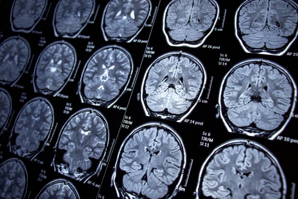 Des chercheurs français découvrent un mécanisme clé de la maladie d'Alzheimer