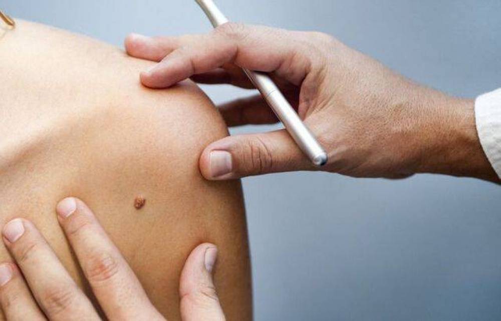 I/O 2021: Google va lancer une appli pour analyser les grains de beauté cancéreux