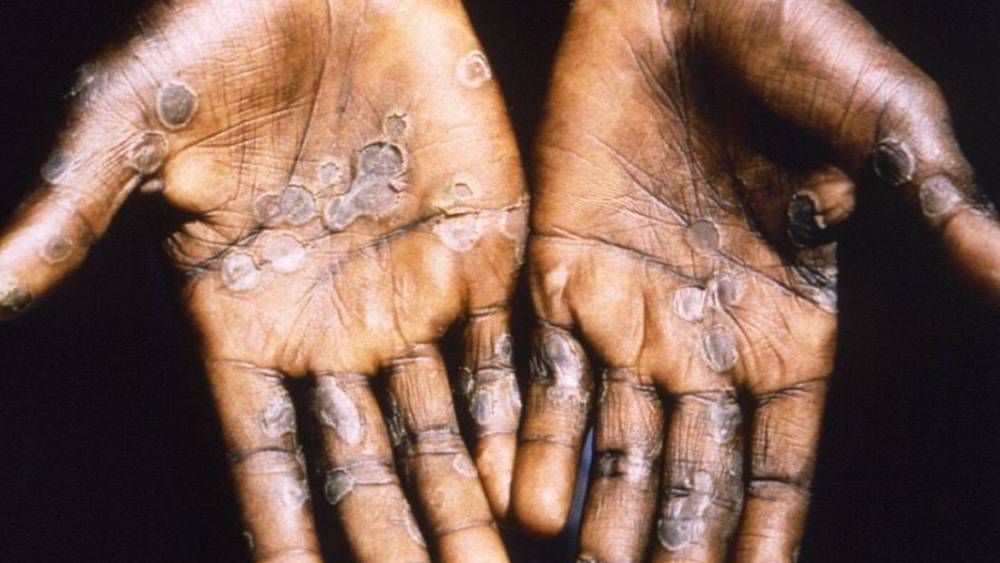 Mpox: le nombre des cas en Afrique a atteint 42.438 dont 8.113 confirmés et 1.100 décès (CDC Afrique)