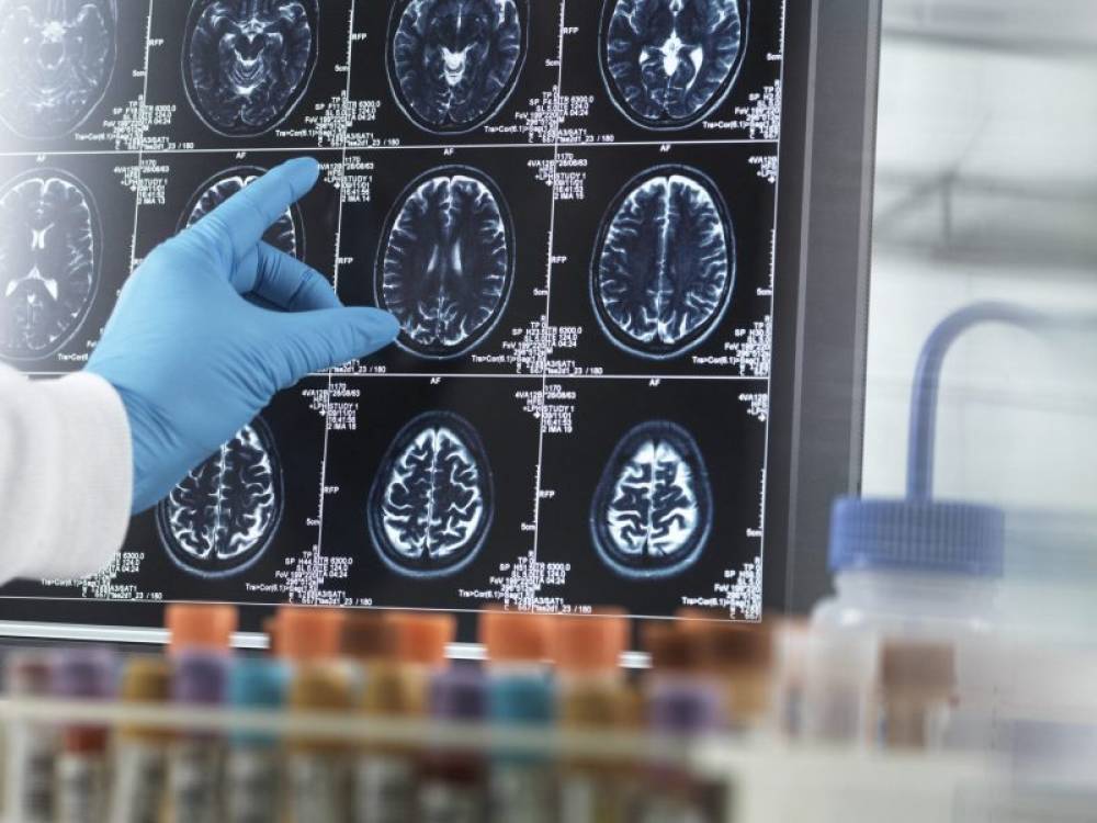 Onze millions de vies perdues par an, l’OMS appelle à agir pour la santé neurologique