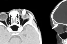 Un gonflement à la paupière cachait une dent chez un adolescent de 16 ans